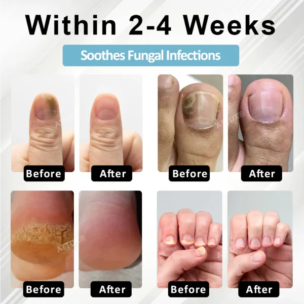 ATTDX® MycoStop Nail Recovery Serum Pen - Image 2