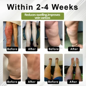 Oveallgo® VeinoRoll Therapy Edema Comfort Cream image Oveallgo® VeinoRoll Therapy Edema Comfort Cream