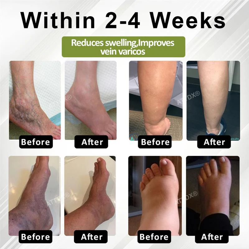 Oveallgo® VeinoRoll Therapy Edema Comfort Cream image Oveallgo® VeinoRoll Therapy Edema Comfort Cream