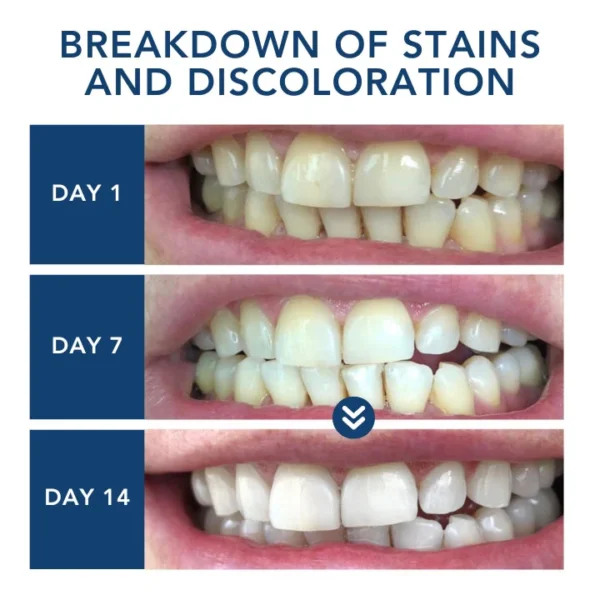 ATTDX® Laser Smile Care Device