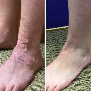 Oveallgo™ VeinCare MagAcupoint Reflexology Insole image Oveallgo™ VeinCare MagAcupoint Reflexology Insole