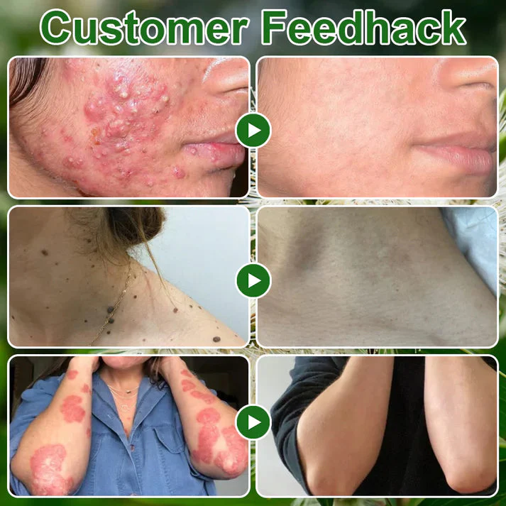 AEXZR® Tea Tree Oil Skin Treatment Cream image AEXZR® Tea Tree Oil Skin Treatment Cream