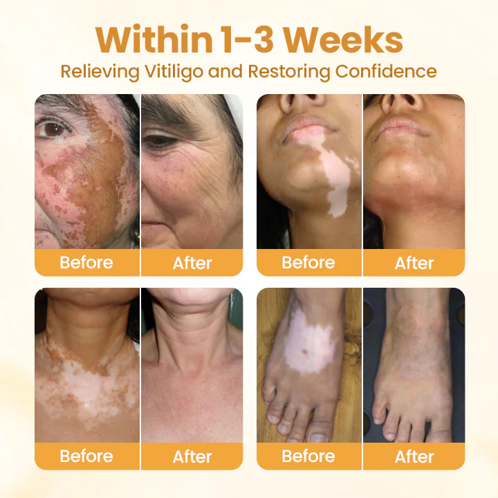 Timilk® VitiCalm Bee Venom Cream 2 Timilk® VitiCalm Bee Venom Cream