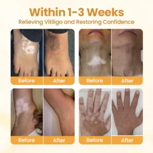 Timilk® VitiCalm Bee Venom Cream 11 Timilk® VitiCalm Bee Venom Cream