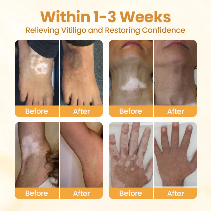 Timilk® VitiCalm Bee Venom Cream 3 Timilk® VitiCalm Bee Venom Cream