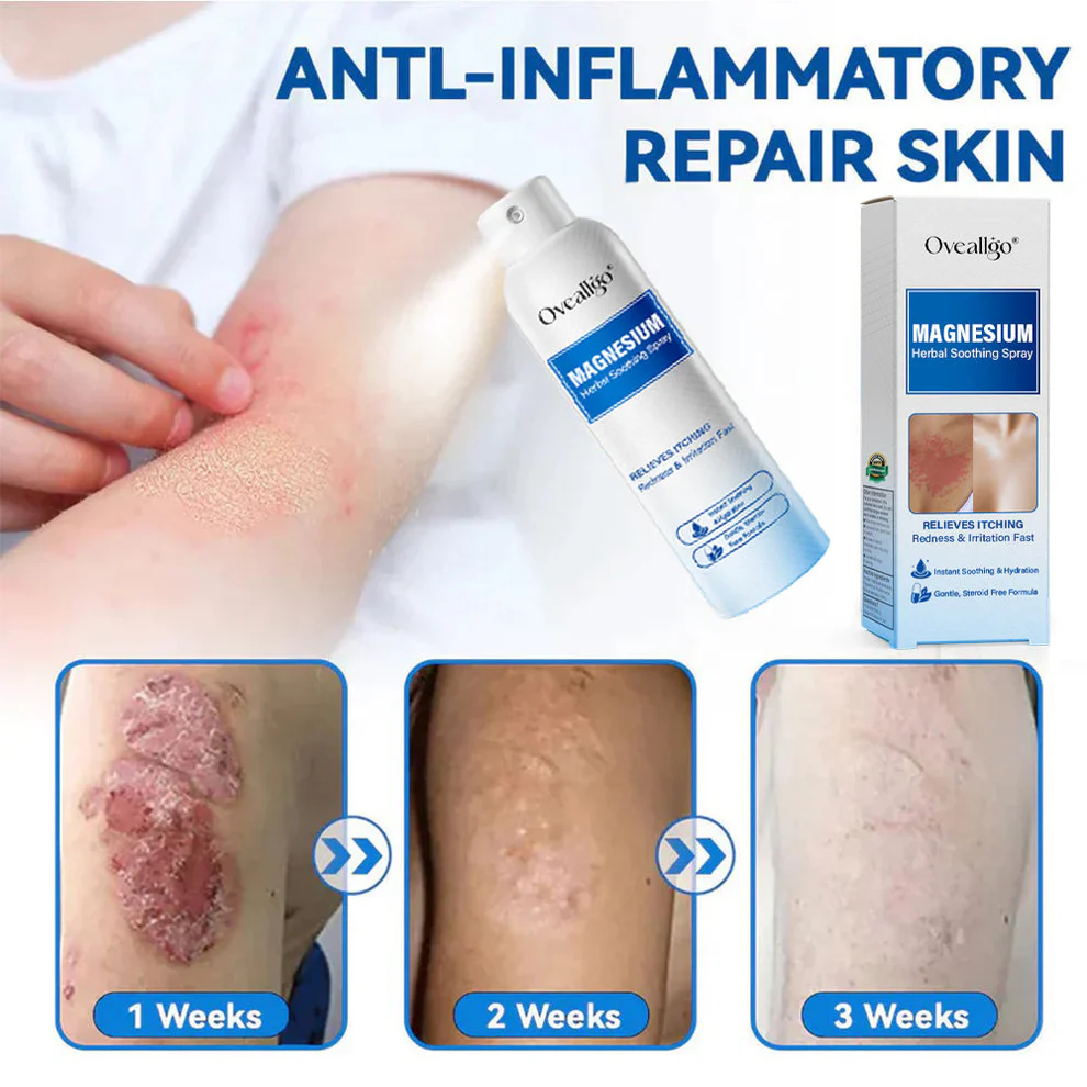 Oveallgo® Magnesium Herbal Psoriasis Spray 10 Oveallgo® Magnesium Herbal Psoriasis Spray