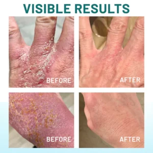 Dobshow® Probiotic + B 24-7 Moisture Eczema Relief Cream 11 Dobshow® Probiotic + B 24-7 Moisture Eczema Relief Cream