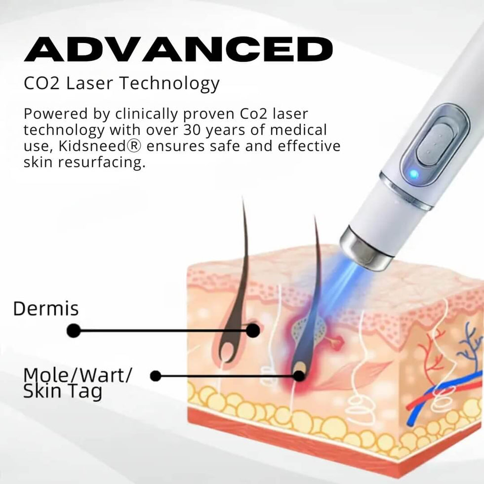 Kidsneed® - Mole and Wart Removal Laser Pen 10 Kidsneed® - Mole and Wart Removal Laser Pen