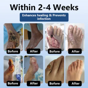 DiabeHeal™ Diabetic Skin Healing Cream image DiabeHeal™ Diabetic Skin Healing Cream