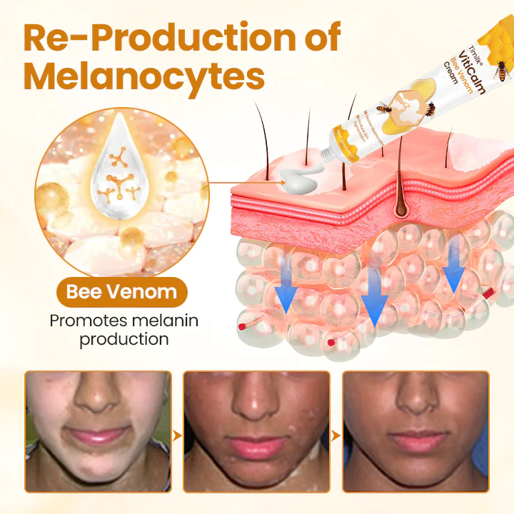 Timilk® VitiCalm Bee Venom Cream 4 Timilk® VitiCalm Bee Venom Cream