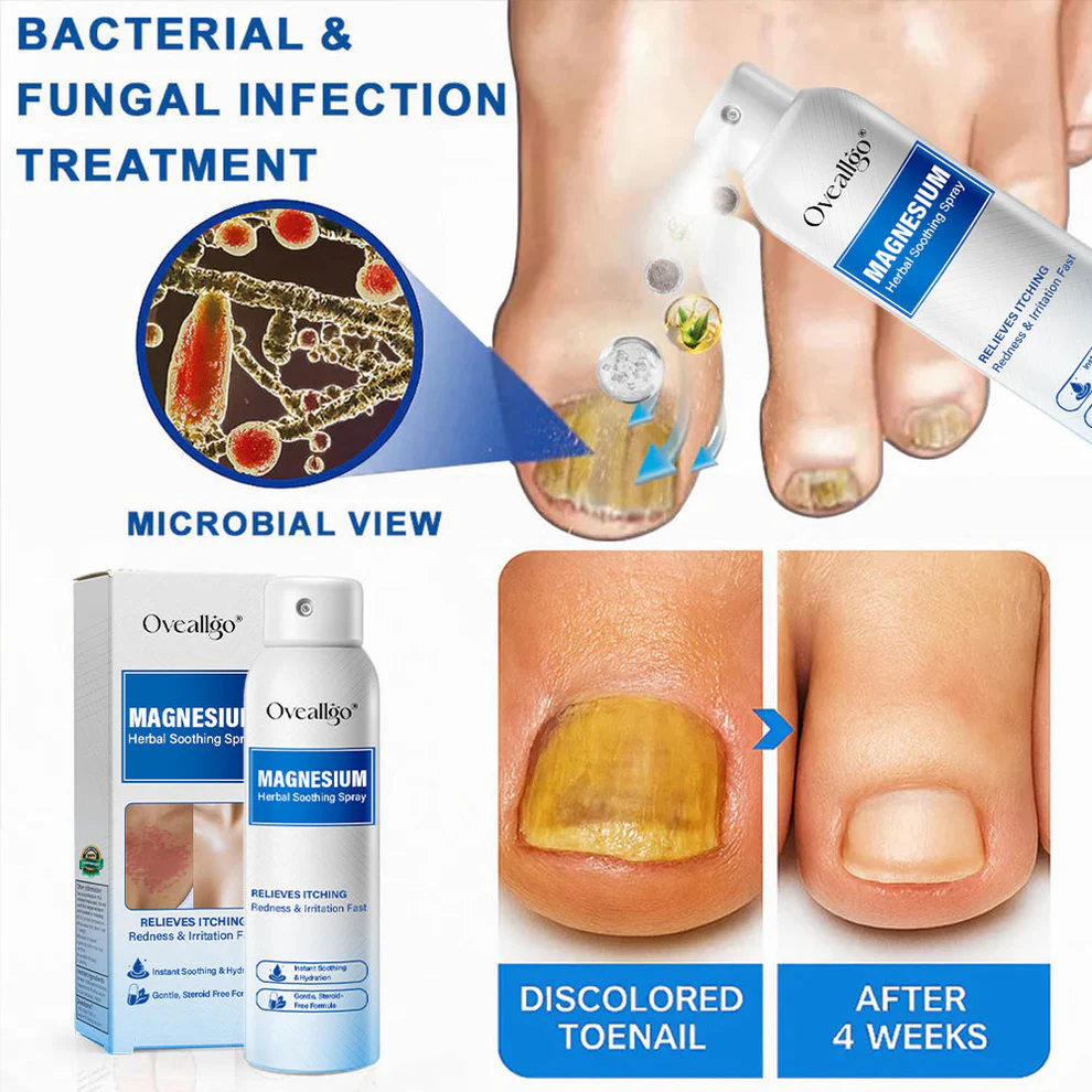 Oveallgo® Magnesium Herbal Psoriasis Spray 5 Oveallgo® Magnesium Herbal Psoriasis Spray