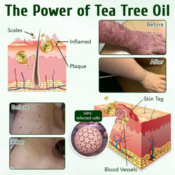 Timilk® DermaPure Tea Tree Healing Cream