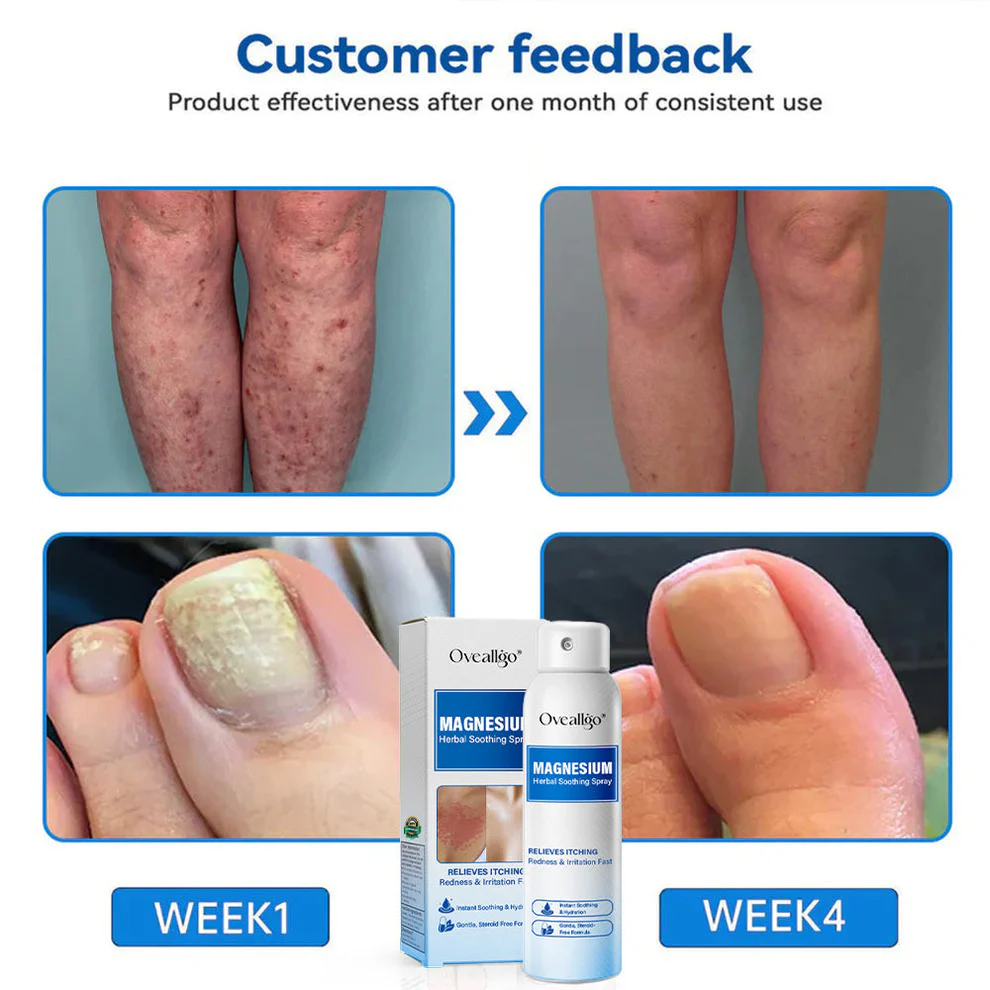 Oveallgo® Magnesium Herbal Psoriasis Spray 2 Oveallgo® Magnesium Herbal Psoriasis Spray