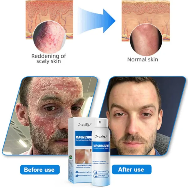 Oveallgo® Magnesium Herbal Psoriasis Spray
