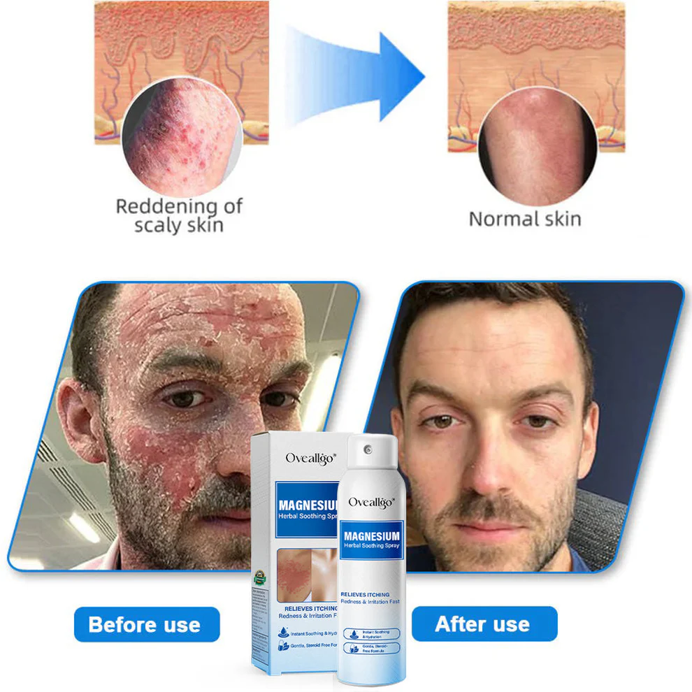 Oveallgo® Magnesium Herbal Psoriasis Spray 8 Oveallgo® Magnesium Herbal Psoriasis Spray