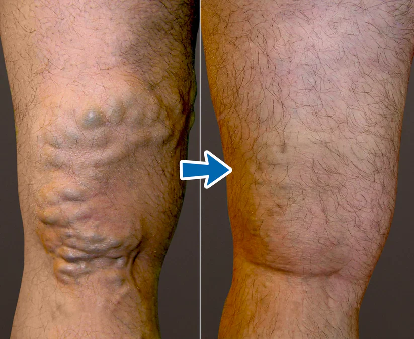 Cvreoz® VenoAid PRO Varicose Solution Spray 5 Cvreoz® VenoAid PRO Varicose Solution Spray