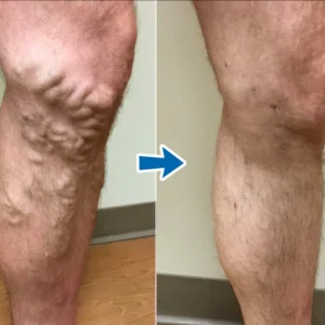 Cvreoz® VenoAid PRO Varicose Solution Spray 11 Cvreoz® VenoAid PRO Varicose Solution Spray