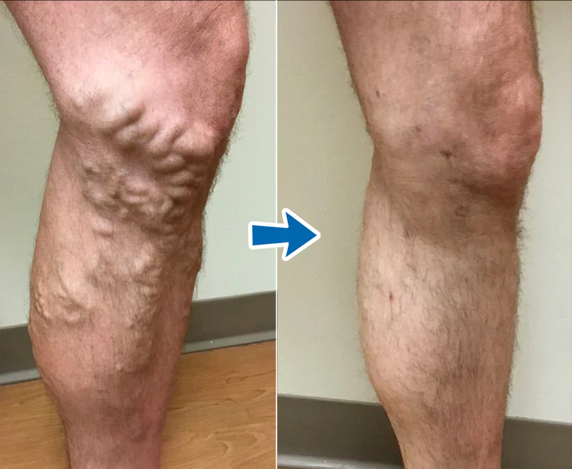 Cvreoz® VenoAid PRO Varicose Solution Spray 6 Cvreoz® VenoAid PRO Varicose Solution Spray