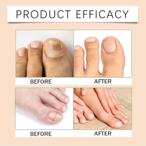 Timilk® FungiBee Advanced Nail Repair Spray image Timilk® FungiBee Advanced Nail Repair Spray