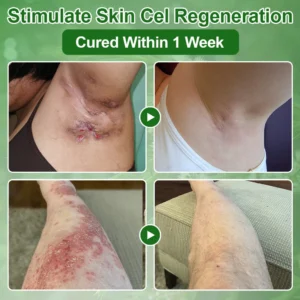 Skavix™ Tea Tree Oil Skin Treatment Cream 13 Skavix™ Tea Tree Oil Skin Treatment Cream