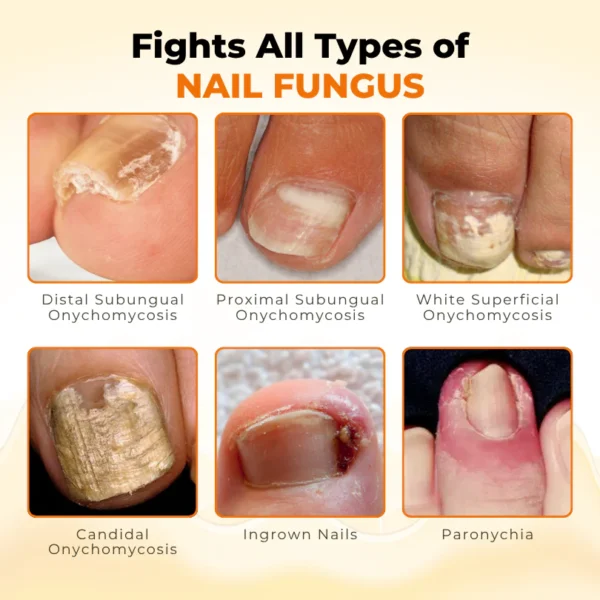 Timilk® NailRevive Bee Venom Anti-fungi Solution