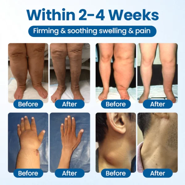Timilk® Lymphora Swelling Relief Roll-On