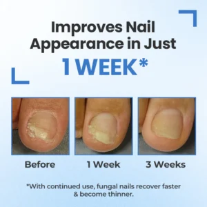 Timilk® MycoErase Nail Revive Pen 21 Timilk® MycoErase Nail Revive Pen