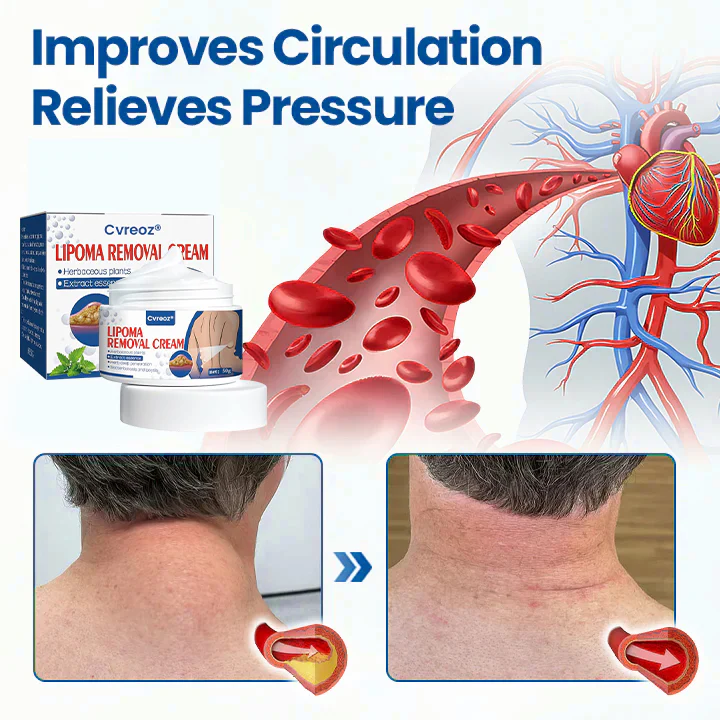 Cvreoz® Lipoma Removal Cream image Cvreoz® Lipoma Removal Cream