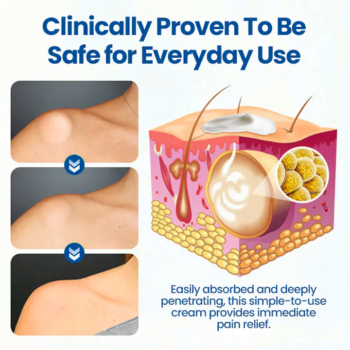 Cvreoz® Lipoma Removal Cream image Cvreoz® Lipoma Removal Cream