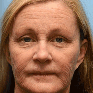 Anti-Wrinkle™ | Botox Wrinkle Removal Cream