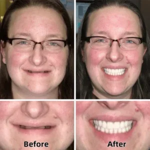 Yagoo™-Custom-Fit Full Functional Dentures image Yagoo™-Custom-Fit Full Functional Dentures