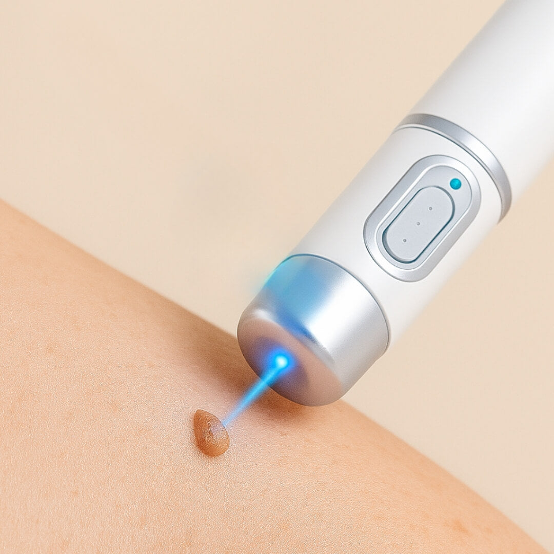 Kidsneed® - Mole and Wart Removal Laser Pen 2 Kidsneed® - Mole and Wart Removal Laser Pen