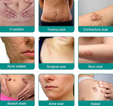 ScarRemove™ Advanced Scar Removal Spray image Fade scars fast with ScarRemove™ Advanced Spray—hydrates, smooths, and restores skin from surgery, burns, or stretch marks naturally.