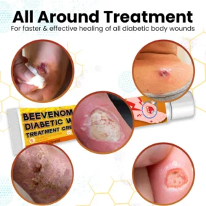 Cvreoz® Bee Venom Diabetic Wounds Treatment Cream 13 Cvreoz® Bee Venom Diabetic Wounds Treatment Cream