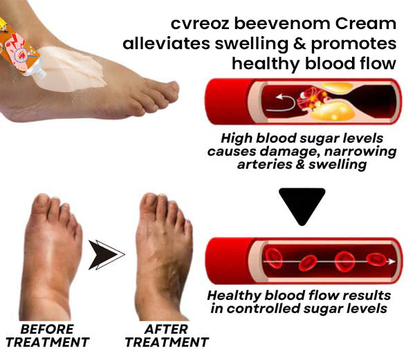 Cvreoz® Bee Venom Diabetic Wounds Treatment Cream 8 Cvreoz® Bee Venom Diabetic Wounds Treatment Cream