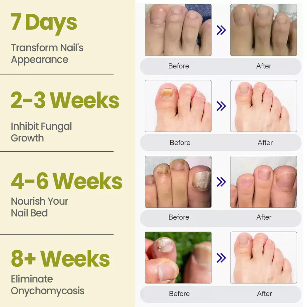 Cvreoz® Nail Fungal Patches Pro+ image Cvreoz® Nail Fungal Patches Pro+