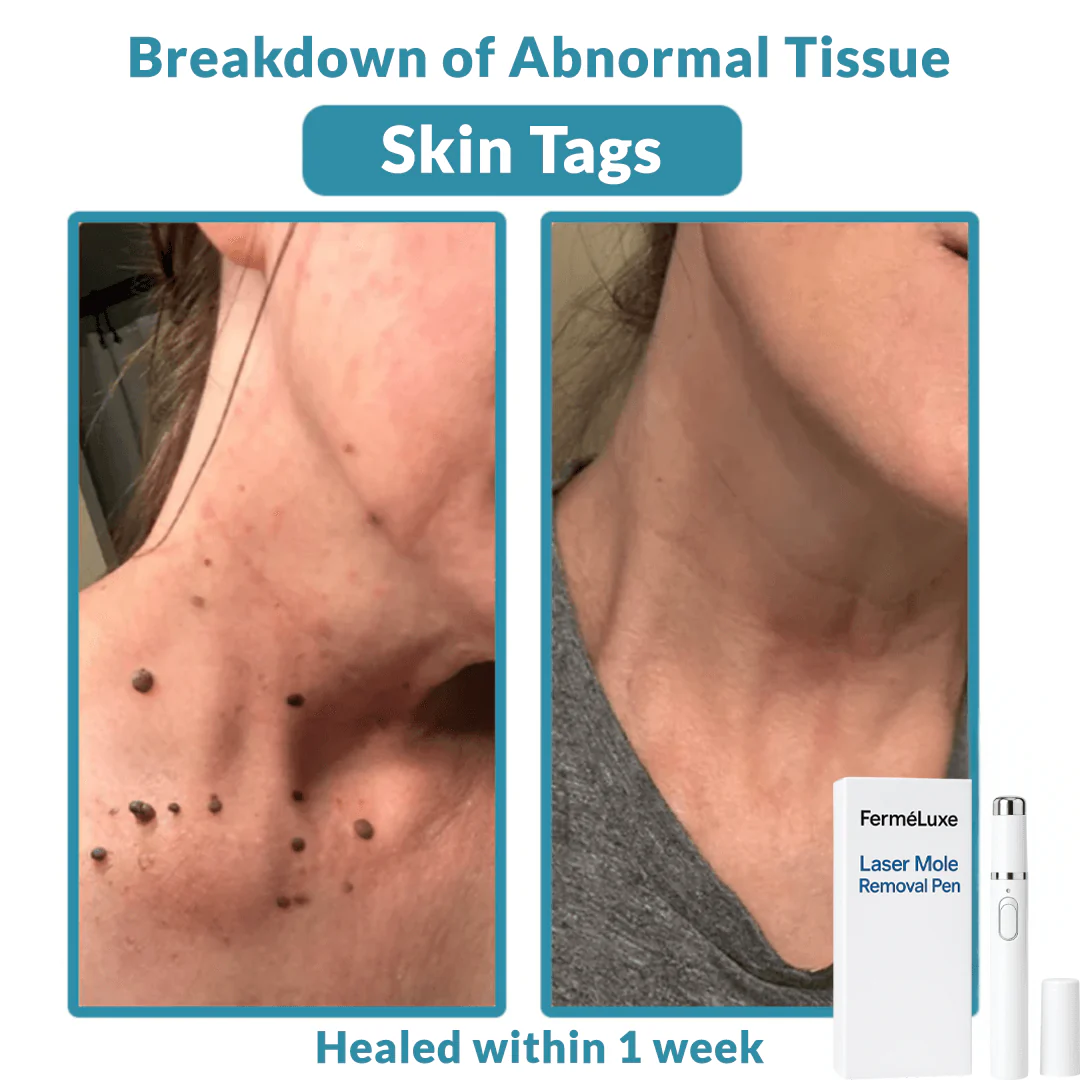FerméLuxe Wart Removal Laser Pen image FerméLuxe Wart Removal Laser Pen