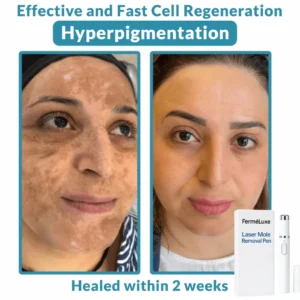 FerméLuxe Wart Removal Laser Pen image FerméLuxe Wart Removal Laser Pen