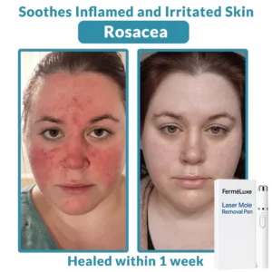 FerméLuxe Wart Removal Laser Pen image FerméLuxe Wart Removal Laser Pen