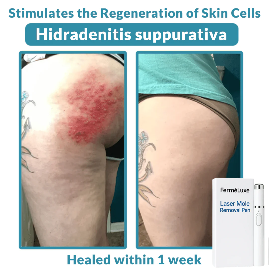 FerméLuxe Wart Removal Laser Pen image FerméLuxe Wart Removal Laser Pen