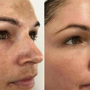 MelantraX – Advanced essence against pigmentation spots image MelantraX – Advanced essence against pigmentation spots