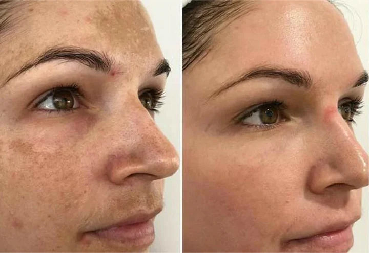 MelantraX – Advanced essence against pigmentation spots image MelantraX – Advanced essence against pigmentation spots