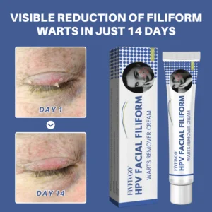 Fivfivgo® HPV Facial Filiform Warts Removal Cream