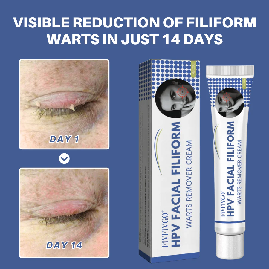 Fivfivgo® HPV Facial Filiform Warts Removal Cream