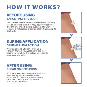 Fivfivgo® HPV Facial Filiform Warts Removal Cream