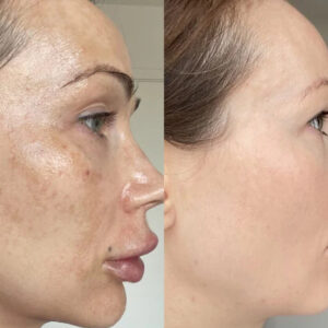 MelantraX – Advanced essence against pigmentation spots image MelantraX – Advanced essence against pigmentation spots