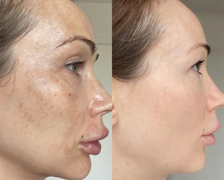 MelantraX – Advanced essence against pigmentation spots image MelantraX – Advanced essence against pigmentation spots