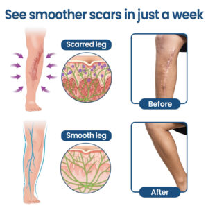 KUBOZN® Triple-Roller Microcurrent ScarRepair Gel
