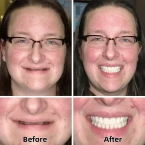 ROSOPL™-Advanced Custom-Fit Functional Dentures image ROSOPL™-Advanced Custom-Fit Functional Dentures