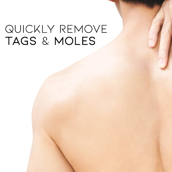 Fivfivgo™ WipeOff Tags & Mole Remover image Fivfivgo™ WipeOff Tags & Mole Remover
